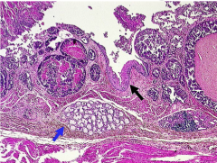 Identify the arrows:
Normal mucosa, normal submucosal glands. What is the condition?
