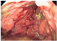 What is this aggressive diffuse cancer? What percent of gastric cancers? What does it result in (wall)?
Is the prognosis good or bad? 
 
Is it resectable?