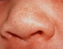 **pearly white/yellow papules; ~1 mm


• usually brow, cheek, & nose


• epidermal cyst caused by accumulation of sebaceous gland secretions


• resolve spontaneously during first weeks


• epstein pearls when found in mouth; will ...