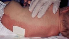 **lying on one side sharply demarcated red color on dependent half of body


• only seen in newborn period; up to 4-6 weeks


• common in LBW


• benign; temporary imbalance of autonomic regulatory mechanism of cutaneous vessels