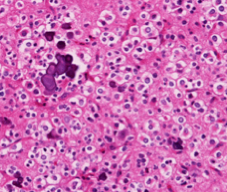 Bilde av snitt fra hjernetumor. Hvilken type tumor er disse cellene typisk for?