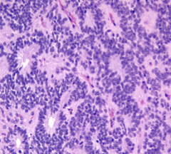 Bilde av snitt fra hjernetumor. Hvilken type tumor er dette typisk for?