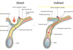Direct inguinal hernia: medial to the vessels via superficial ring. Doesn't descend into the canal
Indirect inguinal hernia: lateral to the vessels through the deep ring. Descends into the canal.