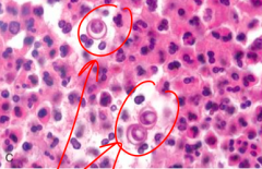 Intact spherules within multinucleate giant cells associated with valley fever