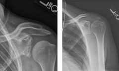 Arthritis (d/t recurrent dislocations damaging the joint / labrum)
- Left image = arthritis
- Right image = normal