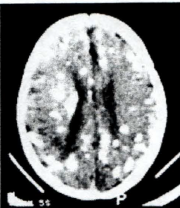 A child is born with neurologic dysfunction and seizures. The CT scan demonstrates finding of which parasitic infection?