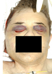 bleeding around eyes
commonly seen w/gunshot wound to head - pressure wave from bullet blows out orbital plates