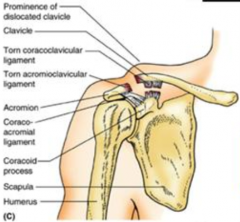Grade II Acromioclavicular sprain:
- AC ligament tear and Coracoclavicular ligament stretch
- Clavicles are even (therefore not grade 3)