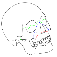 [blue line]

near zygomatic/maxillary suture
- inferior orbit/orbital floor
- nasal bones / septum