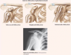- Subcoracoid dislocation
- Subglenoid dislocation
- Subclavicular dislocation
(all anterior, the case 90% of the time)