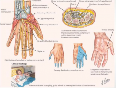 - Thenar wasting (takes >1 month to appear)
- Parasthesias (tingling, pain, or both in sensory distribution of median nerve)
- Cause: compression of median nerve