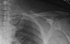 Order clavicle X-ray = fractured