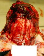 bleeding under the galea aponeurotica (fiberous layer on top of skull)