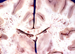 Diffuse axonal injury (DAI)

usually in white matter tracts due to high density of axons