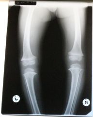 What is the MAIN abnormality in this X-ray?