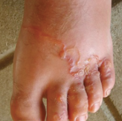A 6 year old child presents with the following rash. What is the MOST LIKELY diagnosis? 