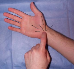 - Tapping over median nerve in carpal tunnel 
- "Positive" causes tingling in the thumb, index, middle finger and the radial half of the fourth digit