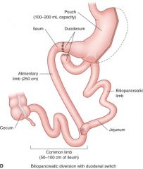 1/2 stomach removed, and a pouch that holds 100-200 mL capacity; intestines rerouted so 60% of small intestine is bypasssed so that only 20% calories are absorbed. Divides intestines into two sections: alimentary limb and the biliopancreatic limb
