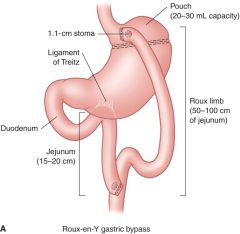 Most common procedure. Staples creat 20-30 mL pouch. Bypasses most of stomach, duodenum, jejuneum
