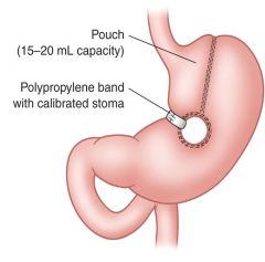 Restrictive procedure, pouch that holds 15-20 mL is created, no bypass occurs
