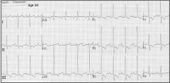 1. ECG- often suggest RV hypertrophy-specifically right axis deviation and right atrial abnormality
2. Echo - dilated pulmonary artery, dilatation/hypertrophy of RA and RV, abnormal movement of the IV septum-- due to increase right ventricular vo...