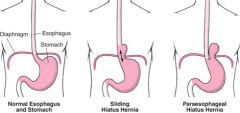 Sliding: most common (90-95%) when upper stomach and gastroesophageal junction are displayed and slides up and down through hiatus
Rolling: all or part of stomach pushees through hiatus and sits next to esophagus
