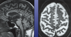 brain shrinks w/age - fills w/fluid
NOT hydrocephalus