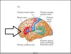 cut off broca's from the rest of the frontal cortex