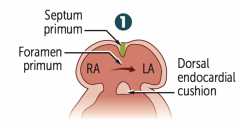 Septum primum grows towards the endocardial cushions, narrowing the foramen primum