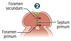 What is the third step in septation of the atria, after the foramen secundum forms in the septum primum?