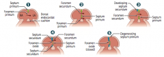 Residual foramen secundum (being closed by septum secundum in step 4)
