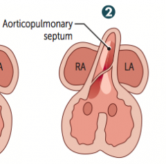 Aorticopulmonary septum rotates and fuses with muscular ventricular septum, closing the interventricular foramen
