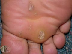 On the foot can cause problems due to pressure forcing them inwards causing pain. 