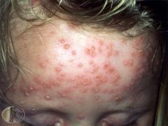 Chickenpox: 90% have had by mid-teens; spread via droplets (incubation ~3 wks); red macules turn to blisters; tend to itch & can heal leaving punched out scars; latent virus remains in dorsal root ganglion

-In adults can cause severe illness - ...