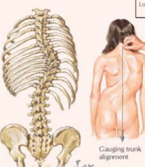 Abnormal lateral curvature of spine, abnormal rotation of one vertebra upon the other
--> genetic, trauma, idiopathic; adolescent girls more than boys