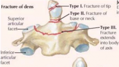 Dens: 3 types - 
I) fracture of tip - usually stable
II) fracture of base or neck - unstable
III) fracture extends into body of axis - reunite well when immobilized