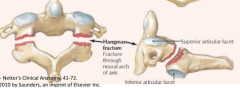 Hangman fracture - through neural arch / pedicle - can be stabilized, if survived with or w/o spinal cord damage