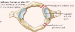 Jefferson fracture - burst fracture of the atlas, often caused by a blow to the top of the head