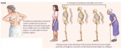 Osteoporosis (porous bone) - imbalance of bone resorption and formation, which places bones at a great risk for fracture