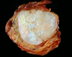 Taken from Parotid.  Why does this tumor reoccur?