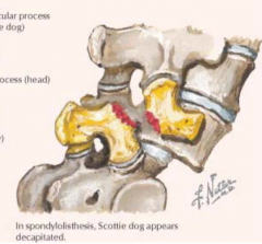 Bilateral defect (complete dislocation) resulting in an anterior displacement of vertebral body and transverse process while posterior fragment remains in proper alignment over sacrum (Scotty dog w/ broken neck)