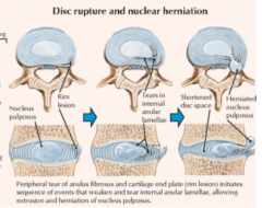 What are the most common sites for disc herniation? Implications?