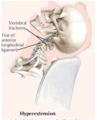 - Cervical hyperextension - stretched or torn cervical muscles and in severe cases, ligament, bone, or nerve damage
- Rear-end vehicular accident