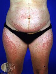 Much more common that pemphigoid gestationis (10-20 times)
-Itchy red papules at end 3rd trimester; +/- widespread erythema, small vesicles, target-like lesions, plaques look like eczema
-Lesions preferentially effect striae, spare umbilicus, spr...
