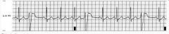  A 45 year old patient in clinic complains that he has felt his heart "skipping beats" intermittently for 2 weeks. He notices it most at rest, less when briskly walking. He denies chest pain, syncope or difficulty breathing. His physical exam i...