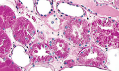 protein accumulation in kidney cells; renal disease
