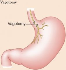 Surgical intervention for peptic ulcer disease; vagus nerve is cut to decrease gastric acid secretion 