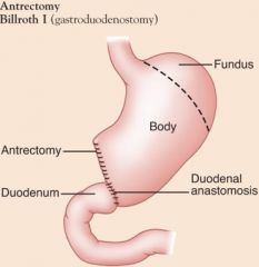 Surgical intervention for peptic ulcer disease; Pylorus is removed and stomach connected to duodenum