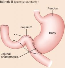 Surgical intervention for peptic ulcer disease; pylorus is removed and stomach connected to jejunum 