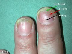 Focal depressions in nail.

Causes: psoriasis, eczema, lichen planus, alopecia areata
